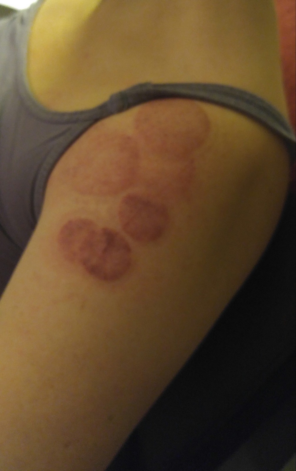 cupping arm