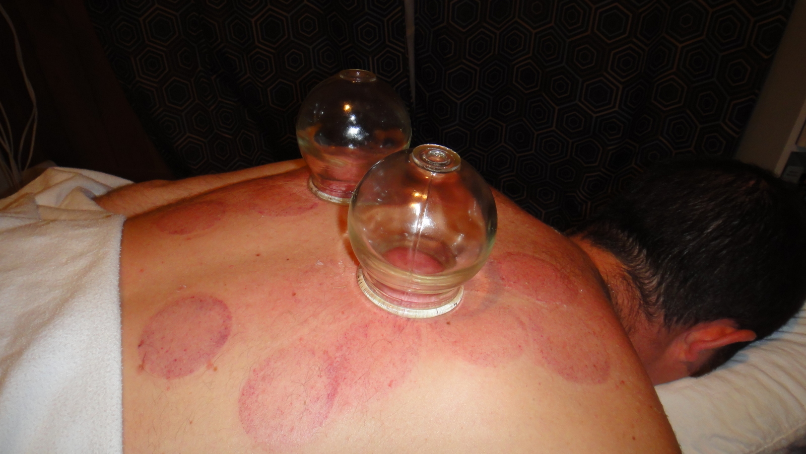cupping back 1
