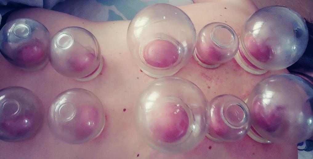 cupping female