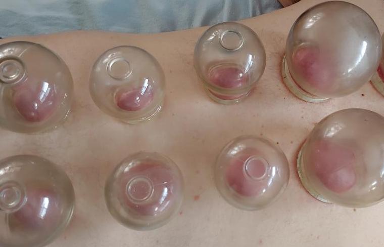 cupping male